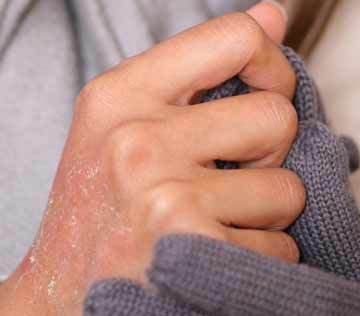 Trockene Haut kann unterschiedlich stark ausgeprägt sein.